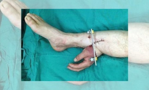 Cirujanos injertan la mano de un hombre en su pierna