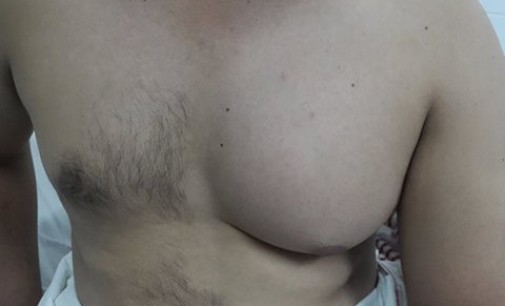 Con éxito intervienen cáncer de mama masculino