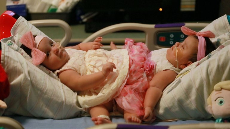 Médicos separan con éxito a gemelas siamesas en EEUU