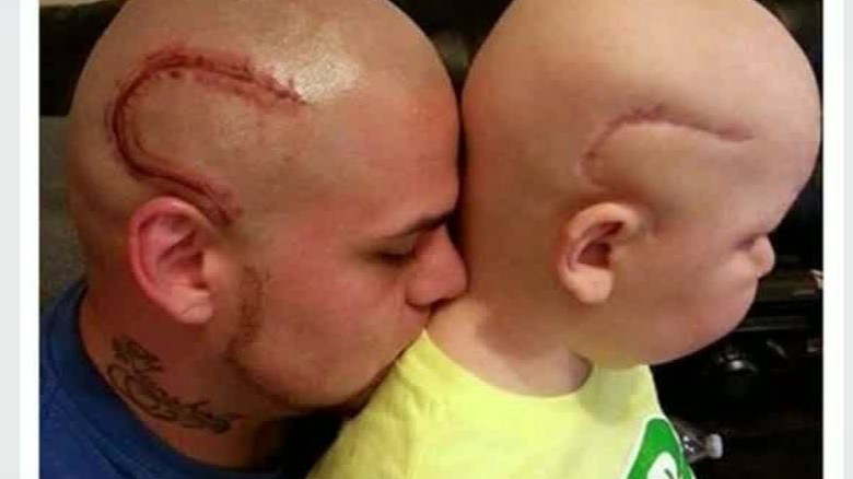 Padre se tatúa en la cabeza la cicatriz de su hijo para apoyarlo en su lucha contra el cáncer