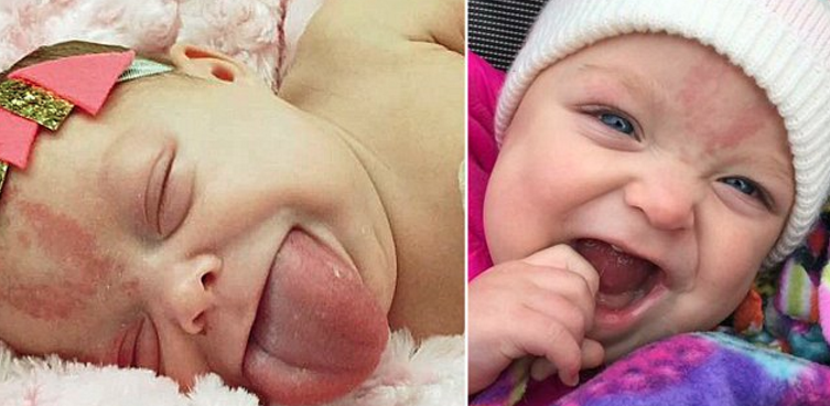 Nació con la lengua del tamaño de un adulto, pero tras una cirugía por fin ha podido sonreír
