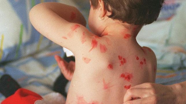 Advierten sobre considerable aumento de varicela en niños