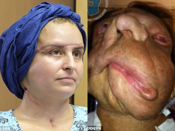 La asombrosa transformación de una mujer que recibió un trasplante de cara