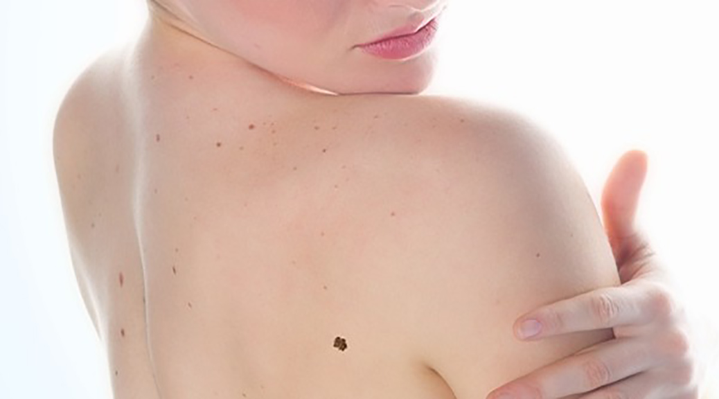 Lunares y manchas pueden avisarte que tienen Cáncer de piel
