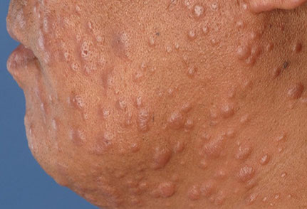 Instan a la ciudadanía a realizarse control de manchas en la piel ante 400 nuevos casos de lepra