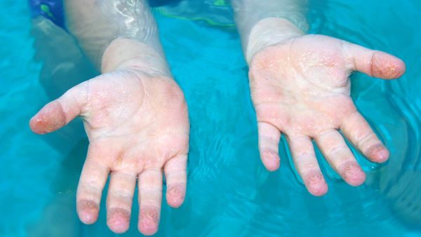 Por qué se arrugan los dedos bajo el agua