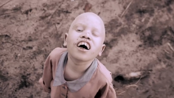 ¿Por qué los albinos de África son acechados por brujos y traficantes?