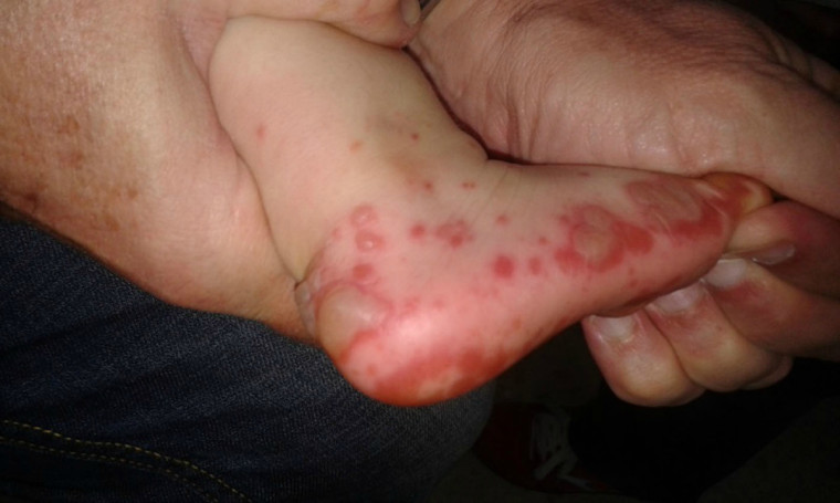 Preocupante aumento de consultas por virus de pies, manos y boca