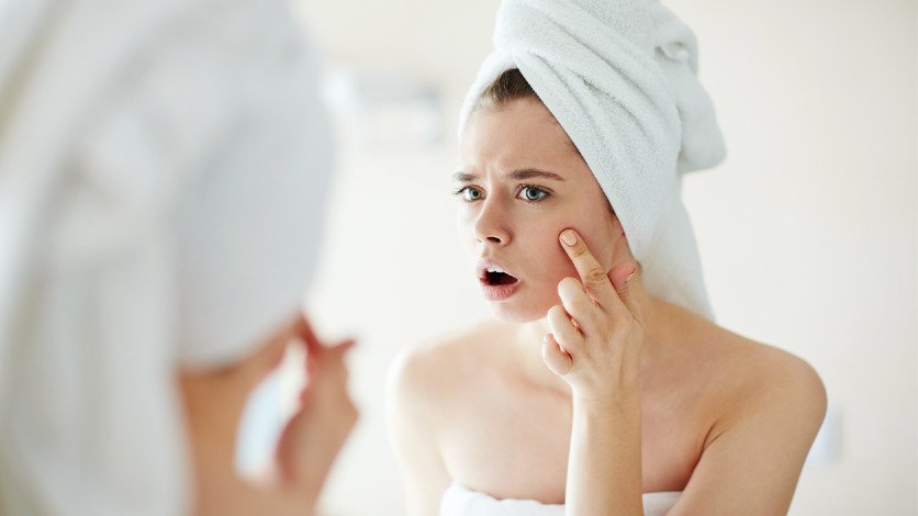 7 remedios para combatir el acné en poco tiempo
