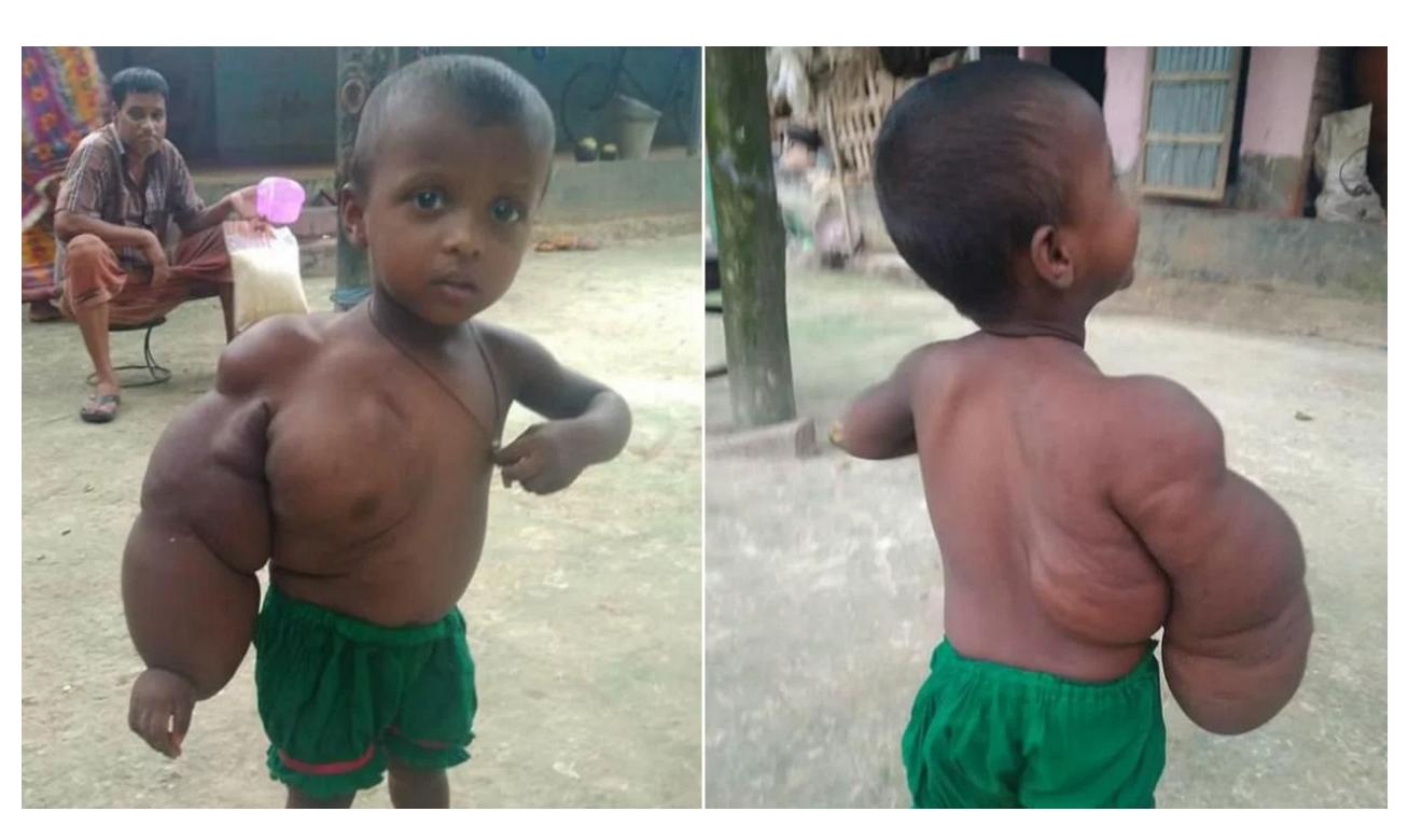 Niña de dos años apenas puede caminar o estar parada por un tumor en el brazo