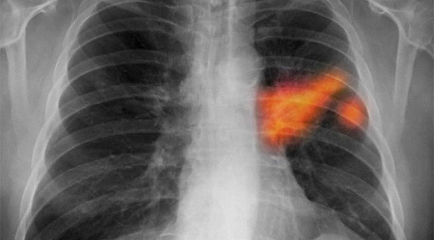 El 90% de los casos de cáncer pulmonar está relacionado al tabaquismo