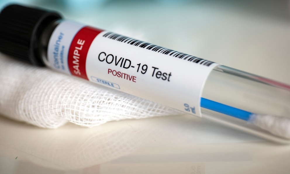 COVID-19:  Salud reporta 2.860 positivos y 107 fallecidos