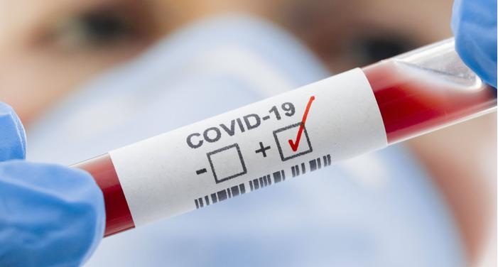 COVID-19: 33 nuevos sin nexo de 124 casos positivos, según informó Salud