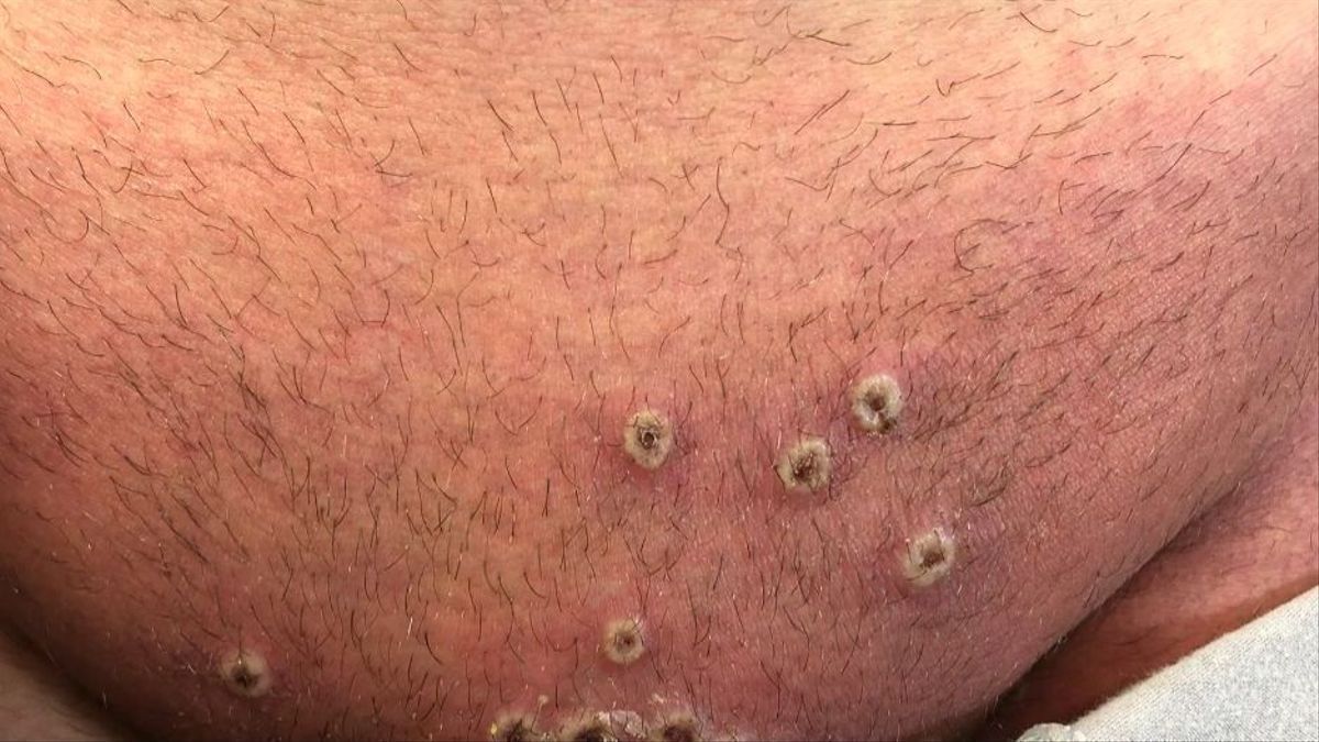 Primer infectado con viruela del mono en Paraguay: Vino de Brasil y es residente de Central